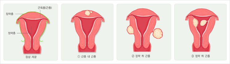 자궁근종의 종류와 시술