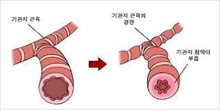 기관지천식