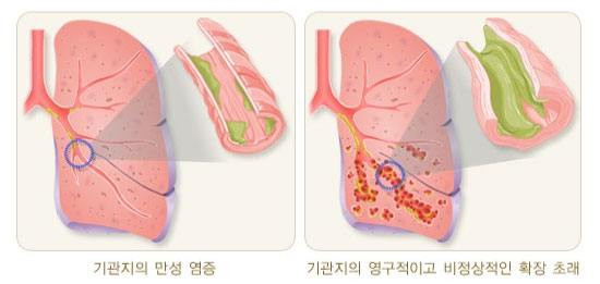 기관지확장증