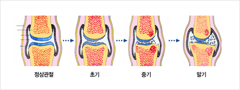 관절의 변화