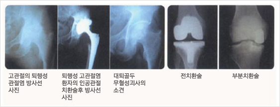 인공관절치환술