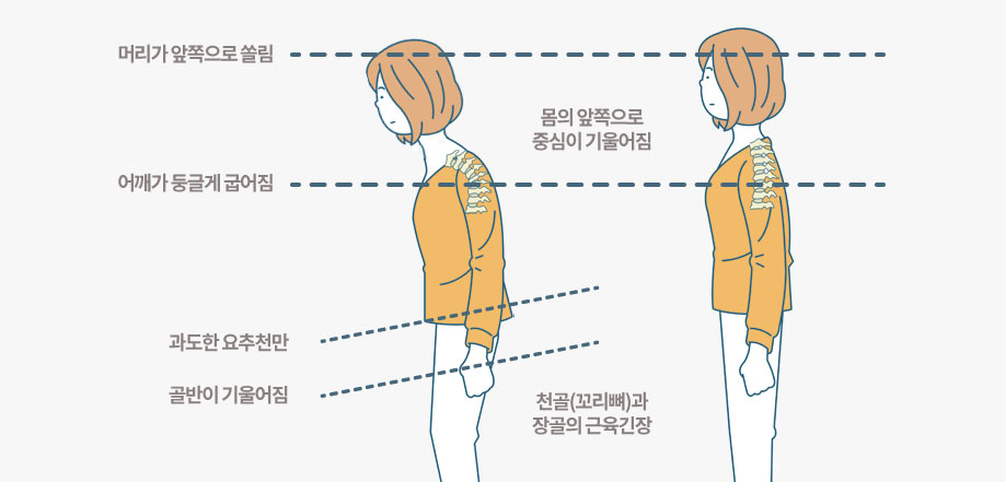 굽은등이란