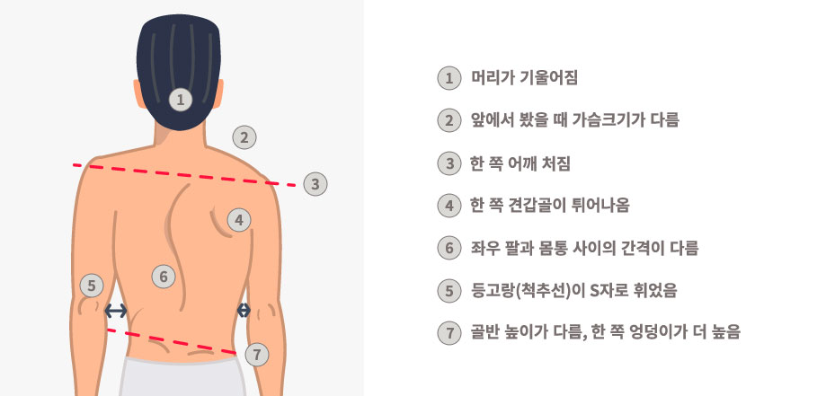 척추측만증증상